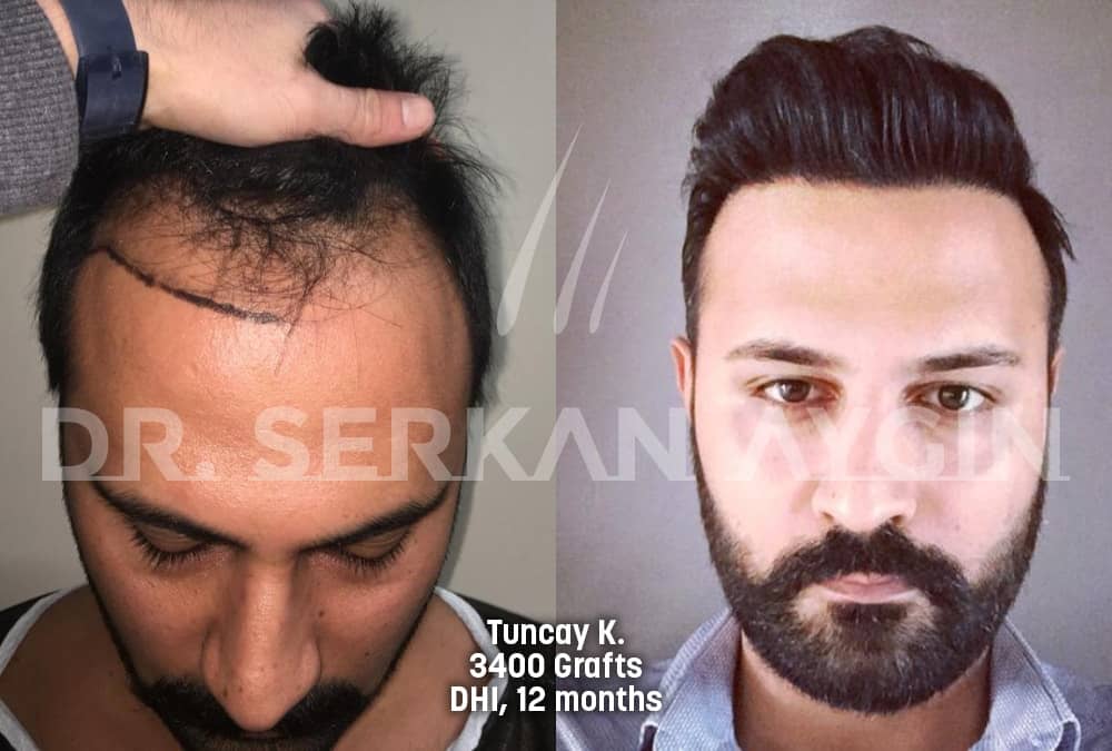 hair transplant before after photo