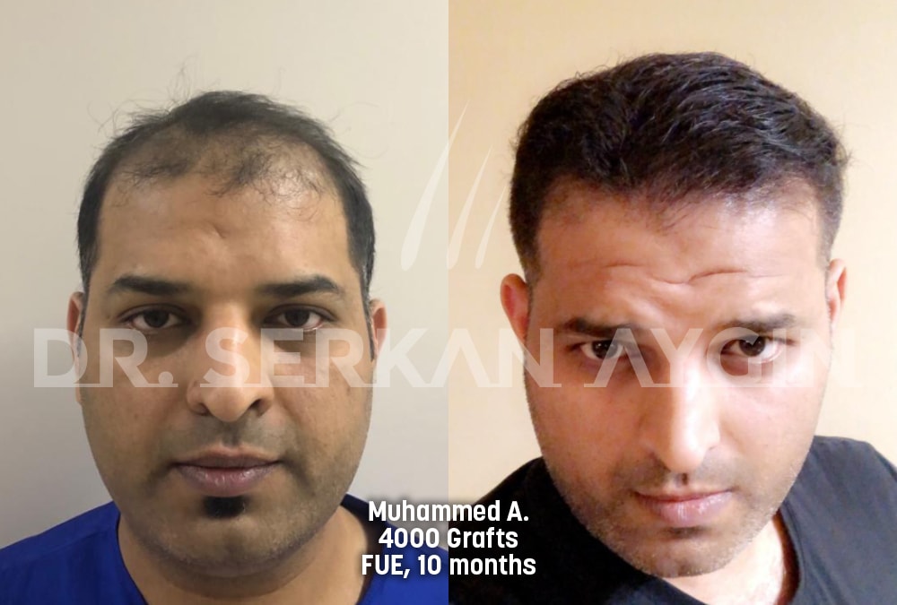 hair transplant before after photo