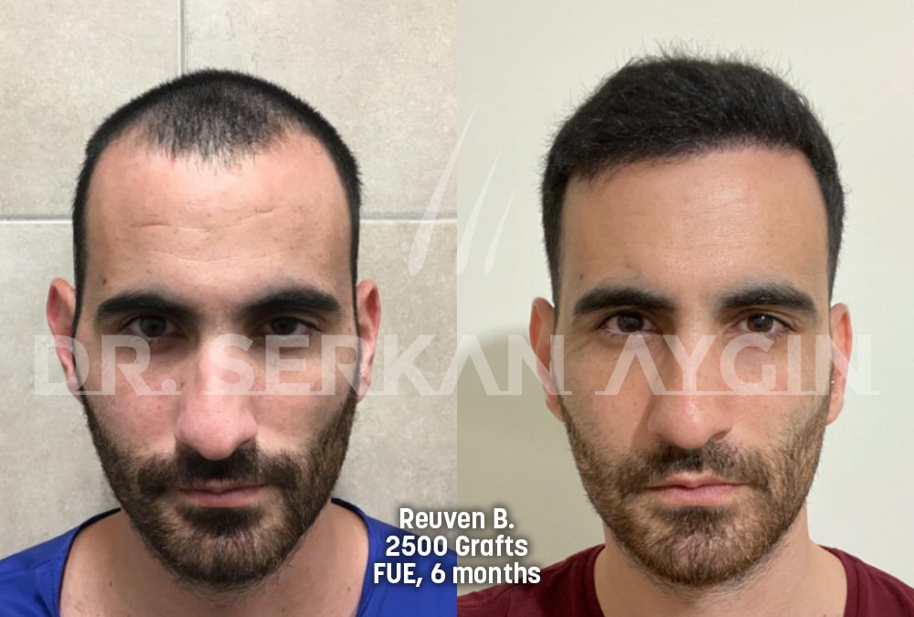 hair transplant before after photo