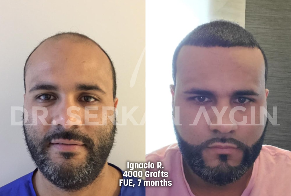 hair transplant before after photo