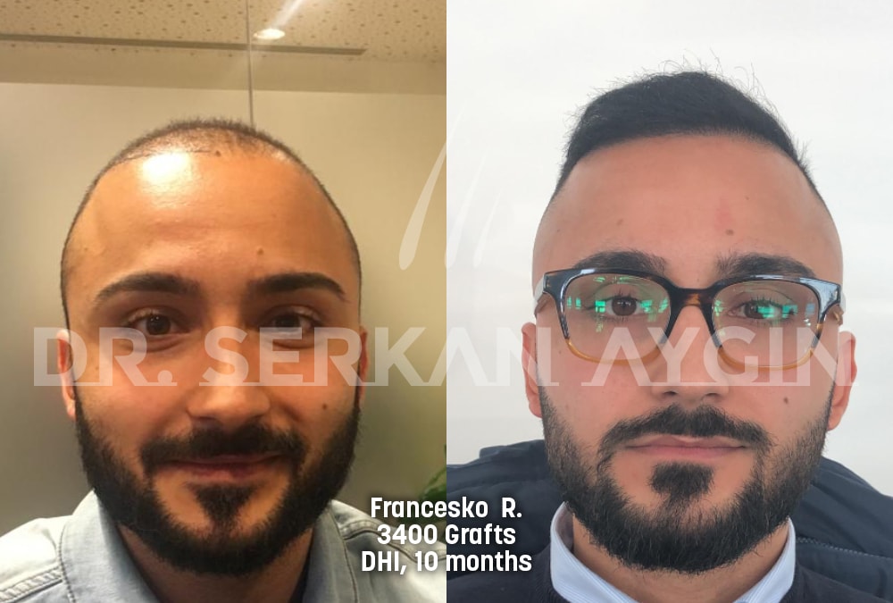 hair transplant before after photo