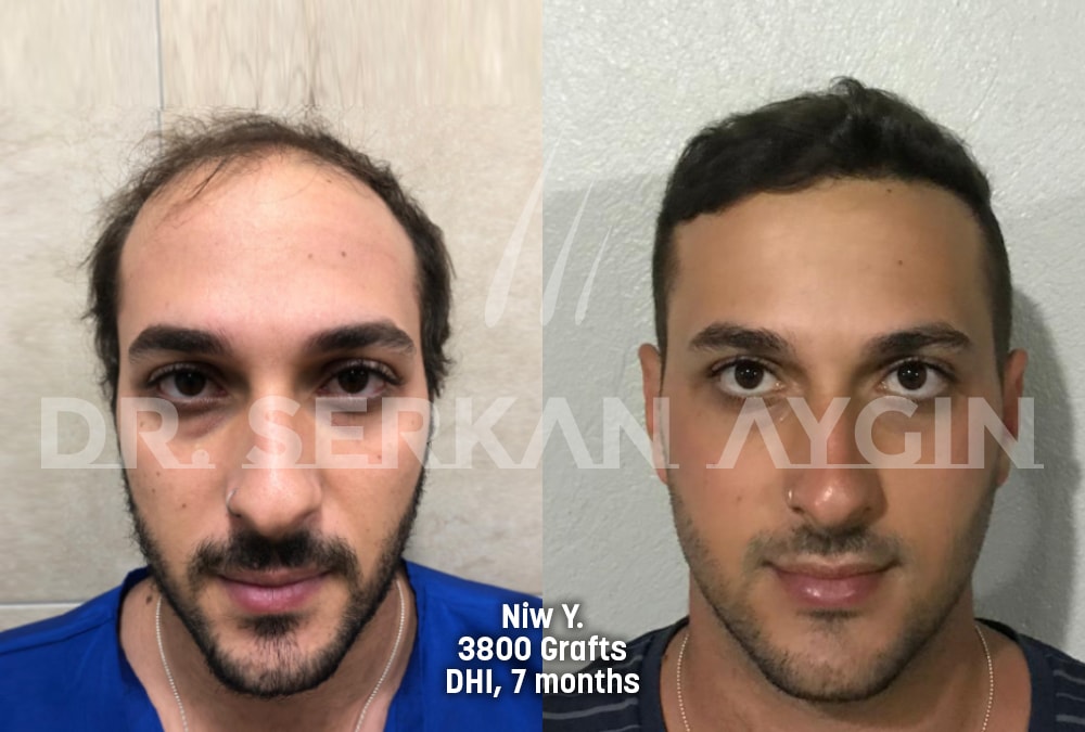 hair transplant before after photo