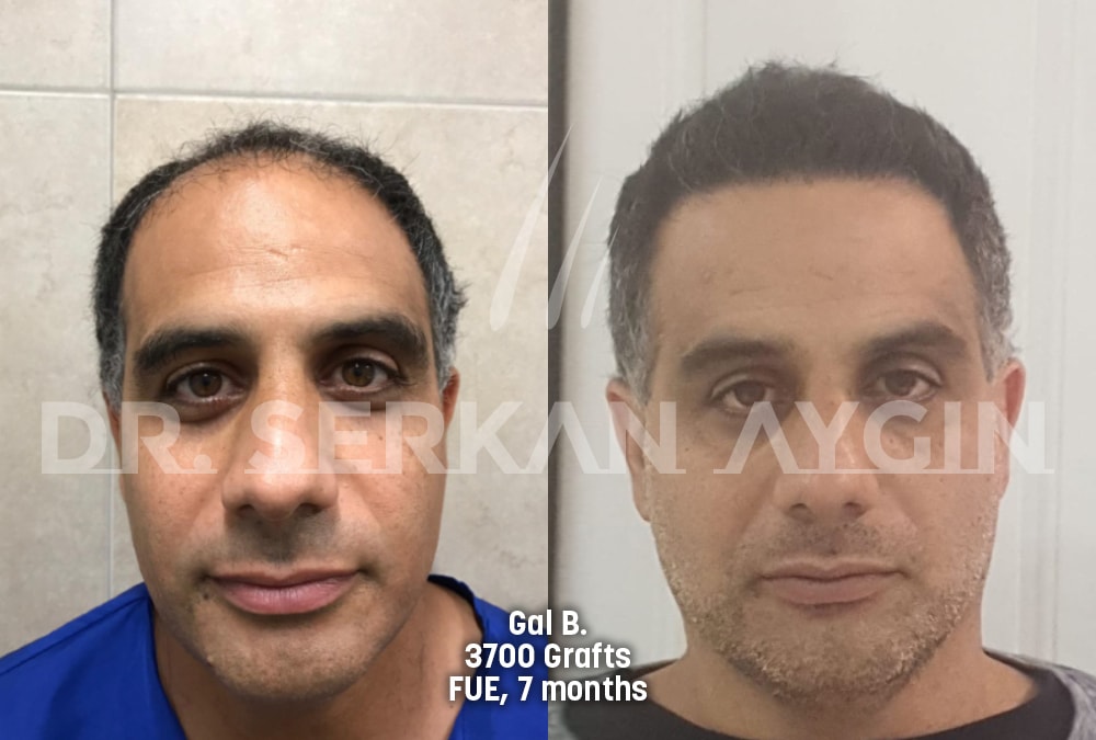 hair transplant before after photo