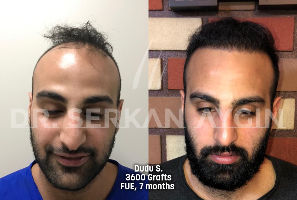 hair transplant before after photo