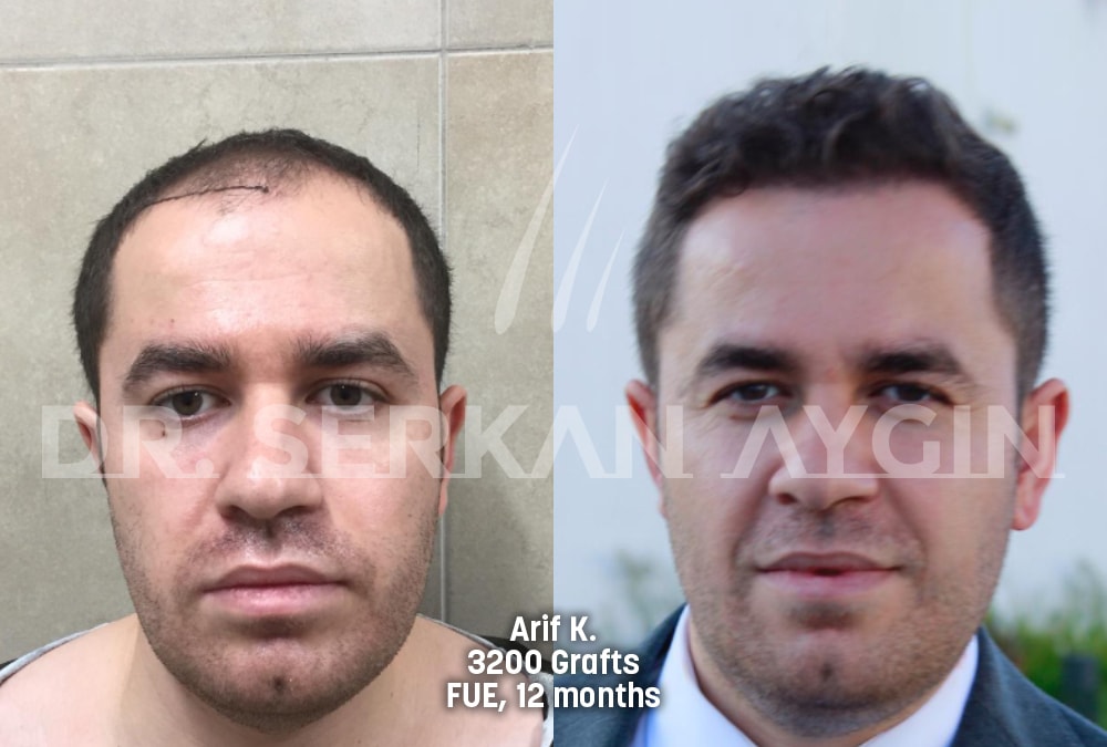 hair transplant before after photo