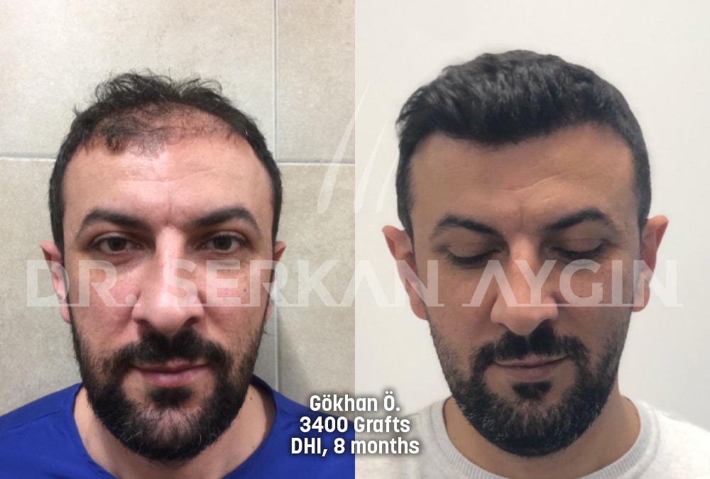 hair transplant before after photo