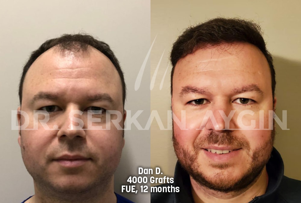 hair transplant before after photo