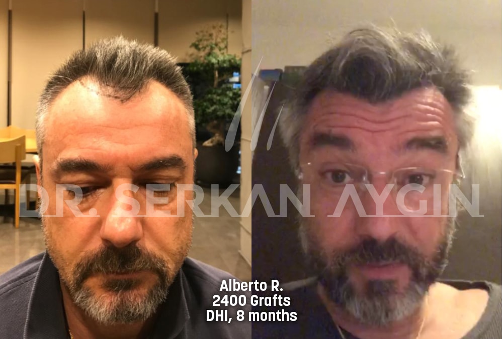 hair transplant before after photo