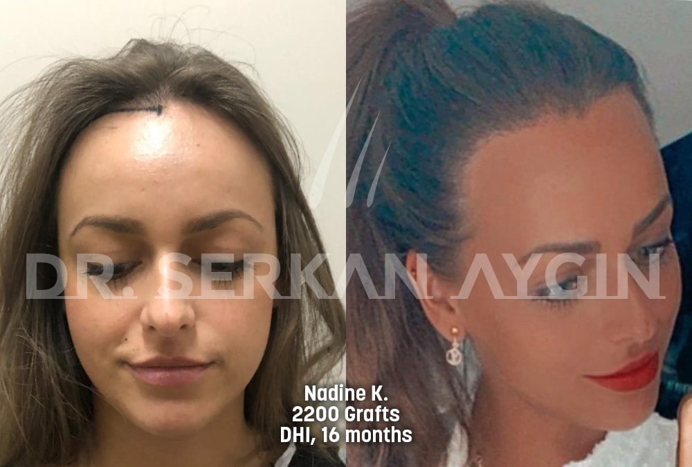 hair transplant before after photo