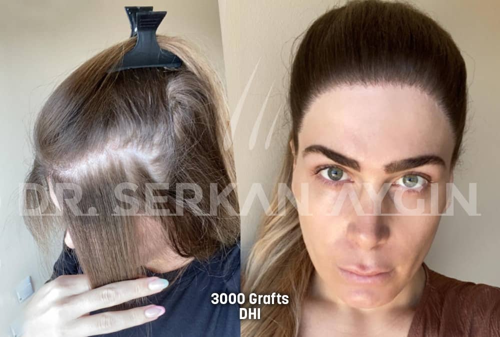 hair transplant before after photo