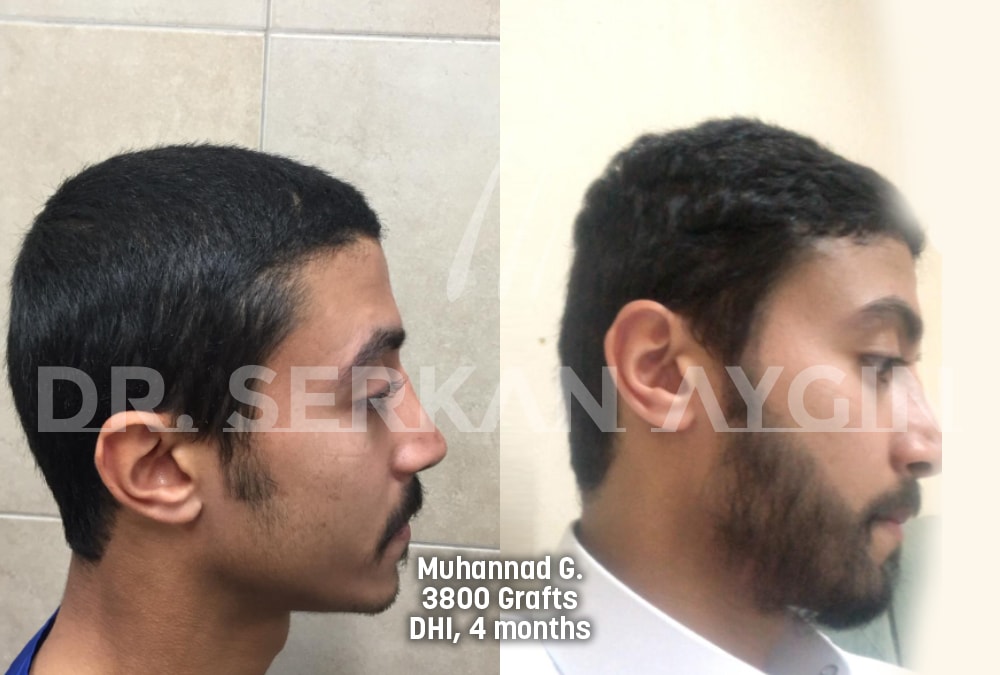 hair transplant before after photo