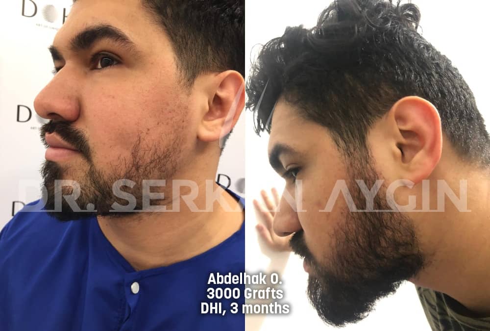 hair transplant before after photo