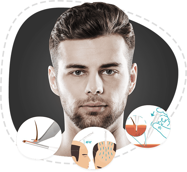 Hair transplant using Choi Implanter Pen